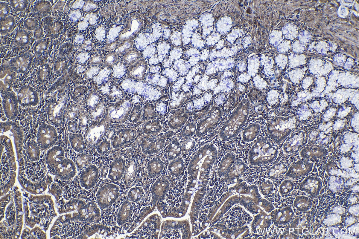 Immunohistochemical analysis of paraffin-embedded human stomach cancer tissue slide using KHC1276 (RAB11FIP5 IHC Kit).
