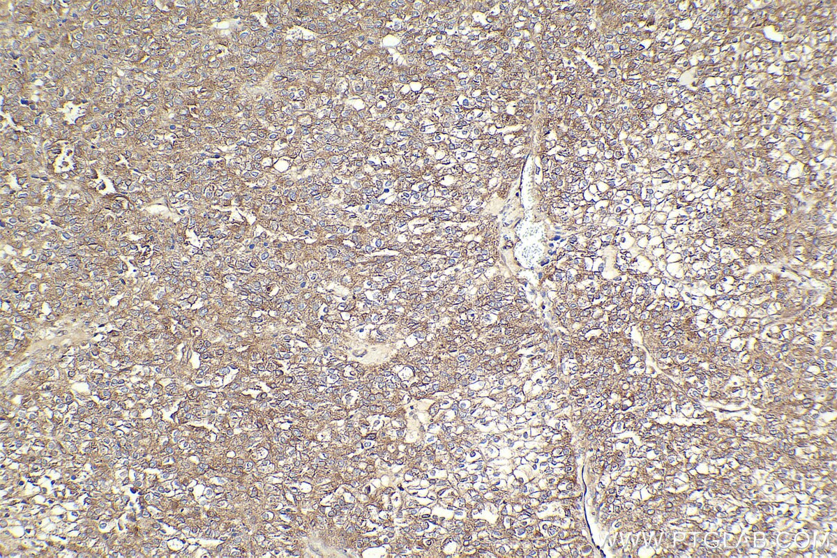 Immunohistochemical analysis of paraffin-embedded human endometrial cancer tissue slide using KHC2302 (RAB13 IHC Kit).