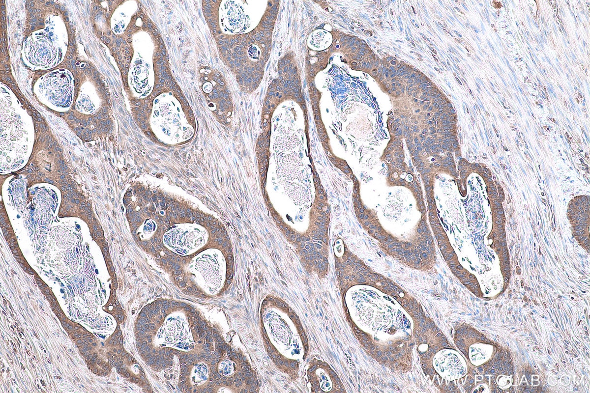 Immunohistochemical analysis of paraffin-embedded human colon cancer tissue slide using KHC0861 (RAB14 IHC Kit).