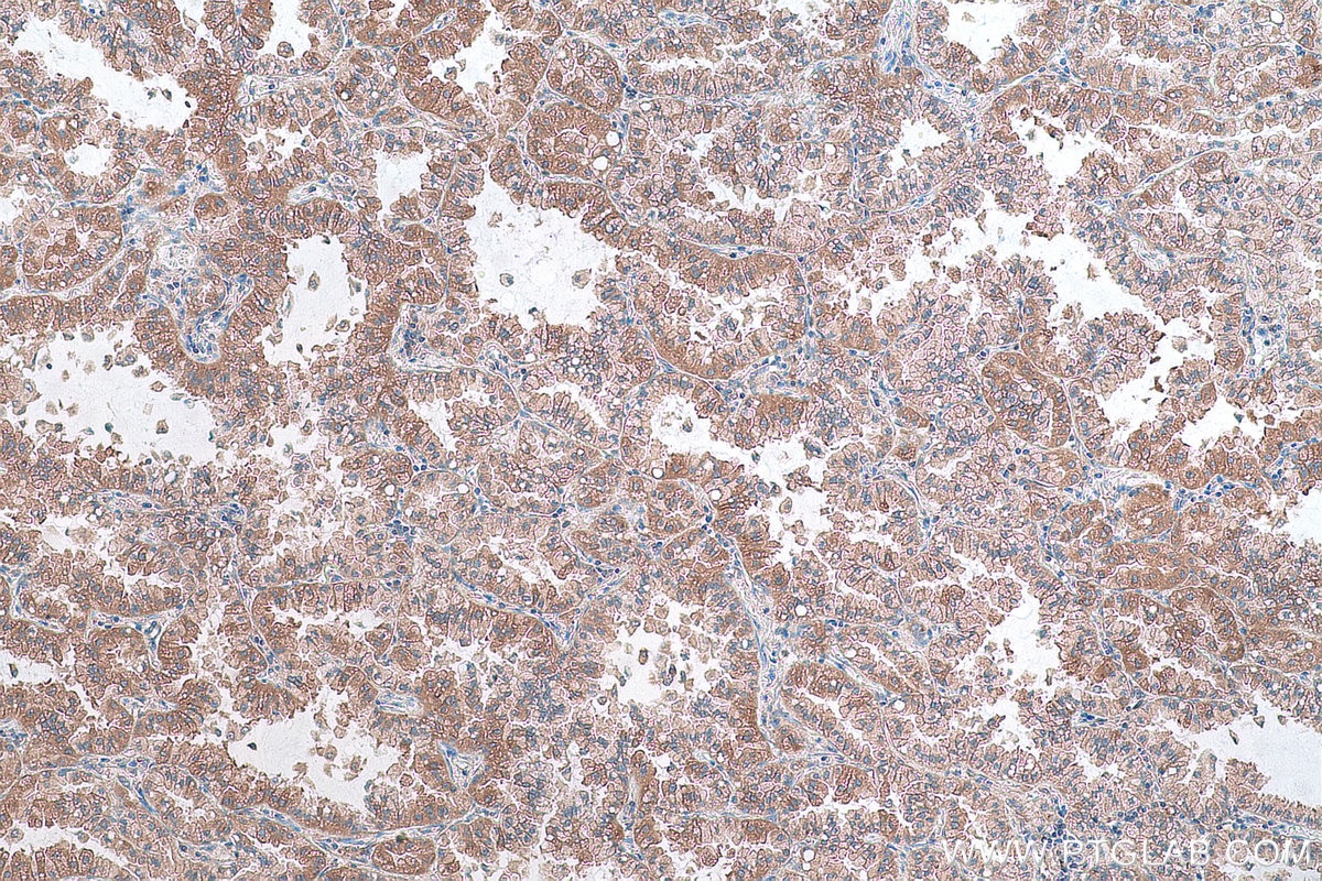 Immunohistochemical analysis of paraffin-embedded human lung cancer tissue slide using KHC0861 (RAB14 IHC Kit).