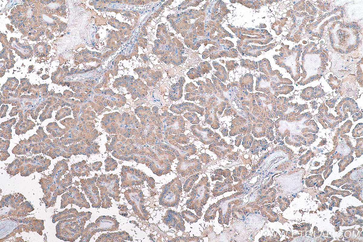 Immunohistochemical analysis of paraffin-embedded human thyroid cancer tissue slide using KHC0861 (RAB14 IHC Kit).