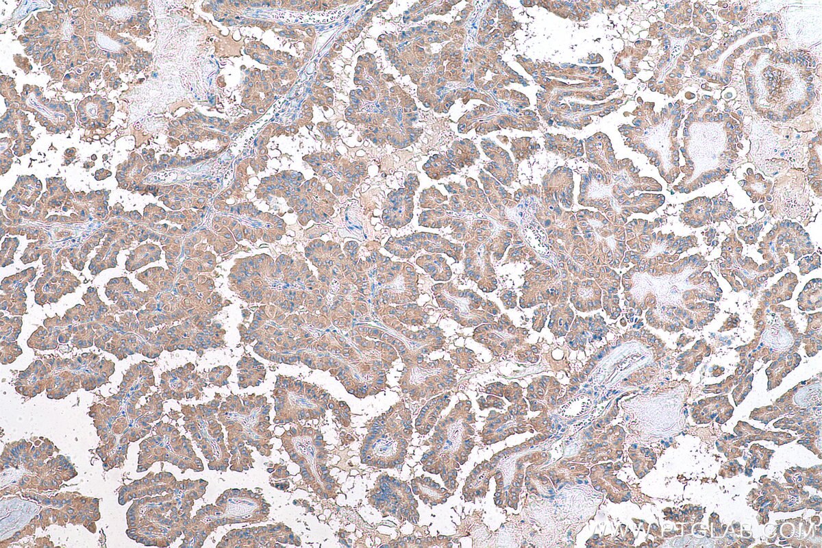 Immunohistochemical analysis of paraffin-embedded human thyroid cancer tissue slide using KHC0861 (RAB14 IHC Kit).