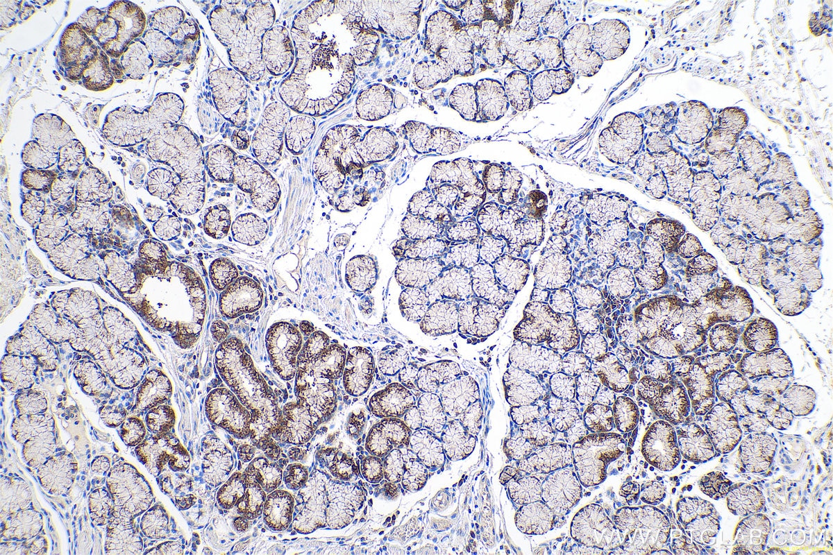 Immunohistochemical analysis of paraffin-embedded human stomach cancer tissue slide using KHC0689 (RAB1A IHC Kit).