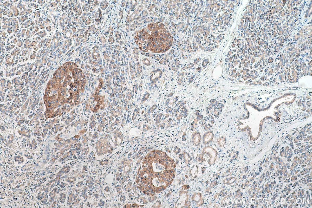 Immunohistochemical analysis of paraffin-embedded human pancreas cancer tissue slide using KHC0689 (RAB1A IHC Kit).