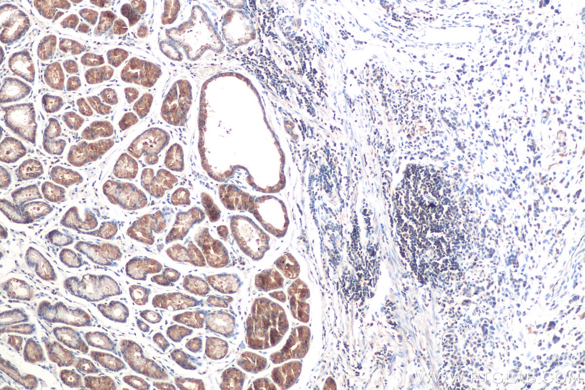 Immunohistochemical analysis of paraffin-embedded human stomach cancer tissue slide using KHC0838 (RAB1B IHC Kit).