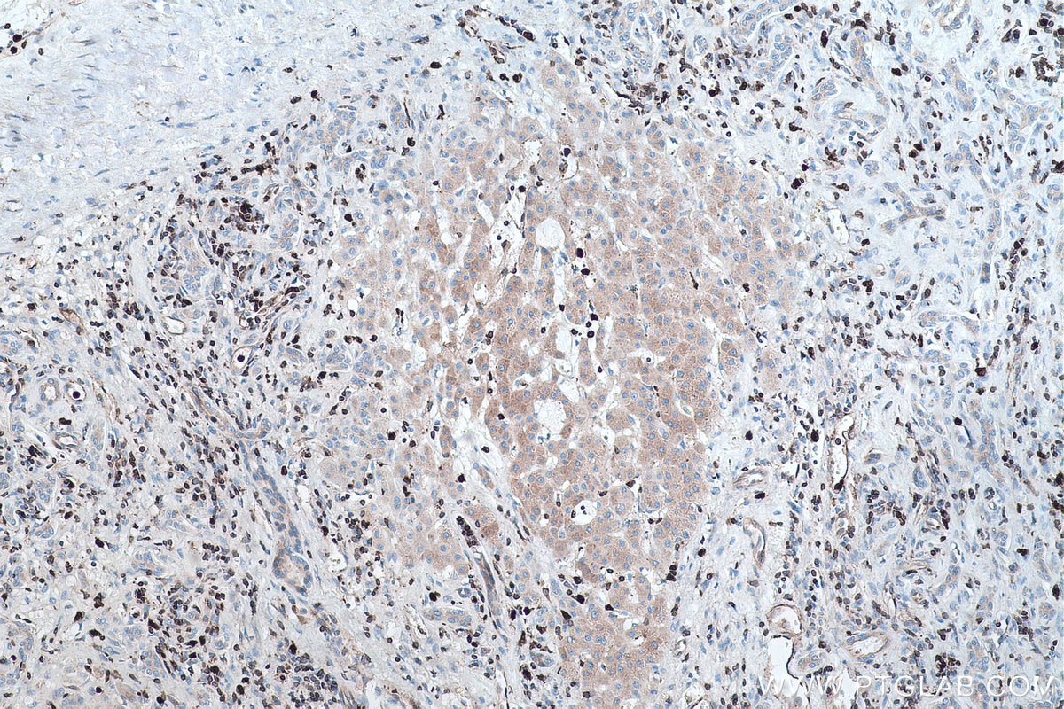 Immunohistochemical analysis of paraffin-embedded human liver cancer tissue slide using KHC0450 (RAB27A IHC Kit).