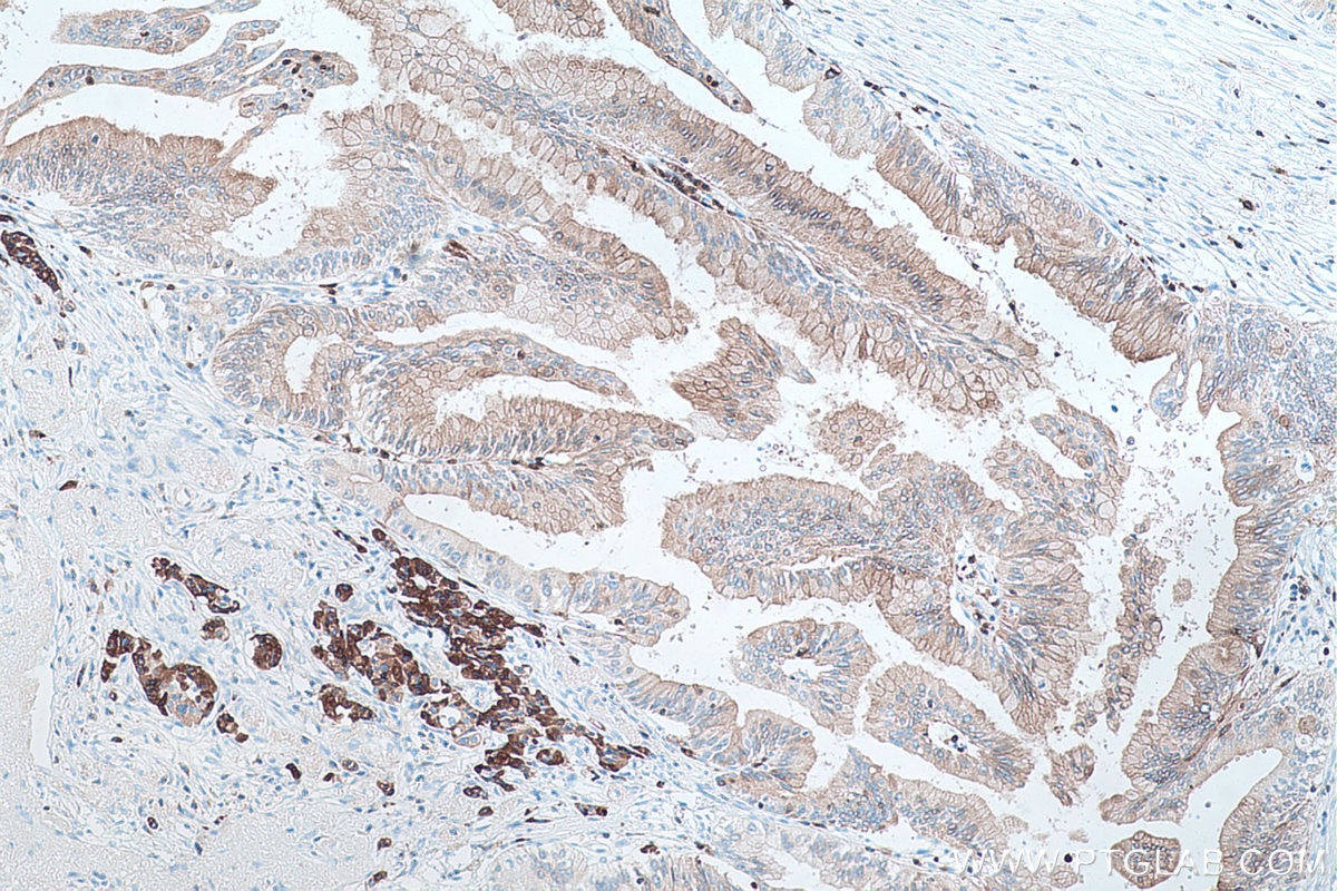 Immunohistochemical analysis of paraffin-embedded human pancreas cancer tissue slide using KHC0450 (RAB27A IHC Kit).