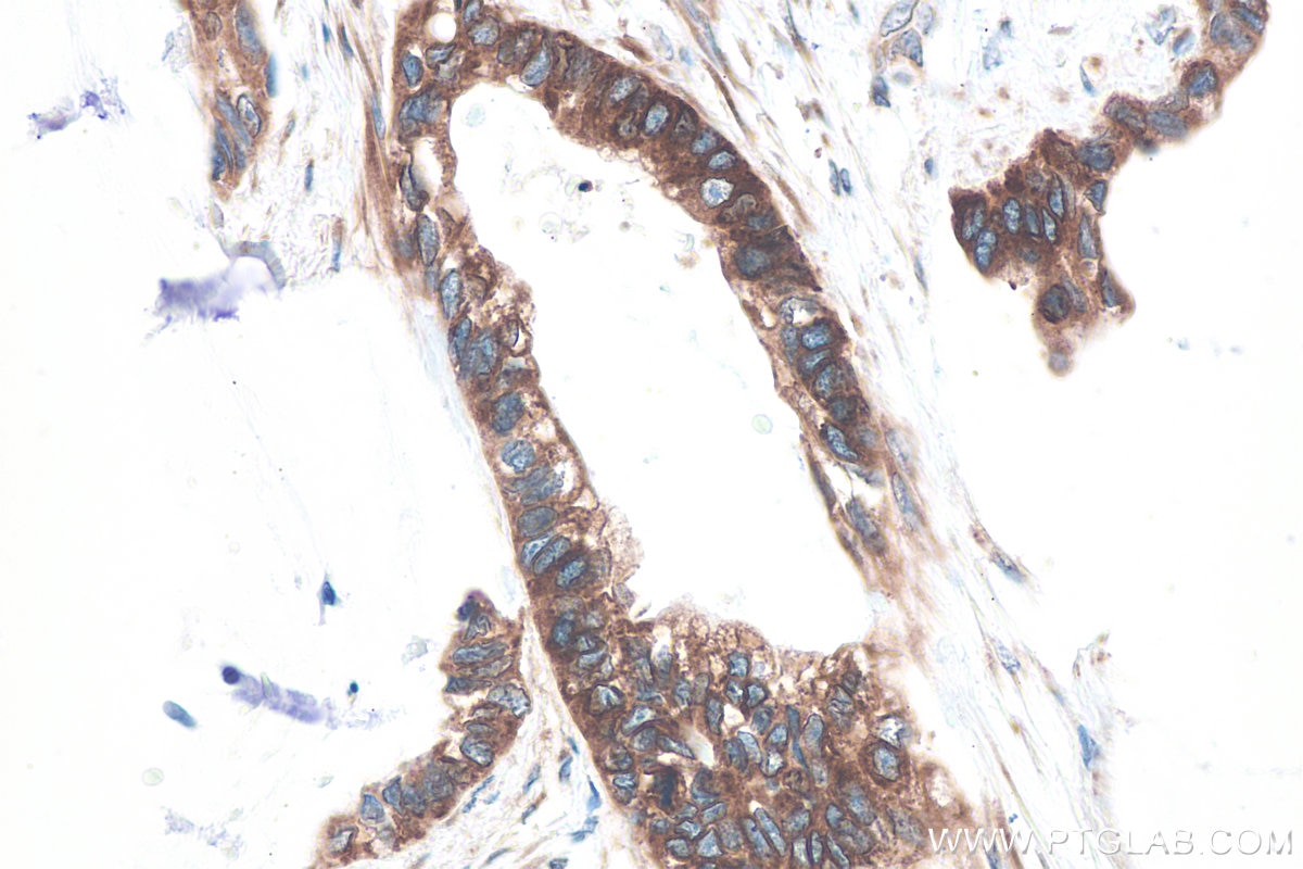 Immunohistochemical analysis of paraffin-embedded human urothelial carcinoma tissue slide using KHC0912 (RAB2A IHC Kit).