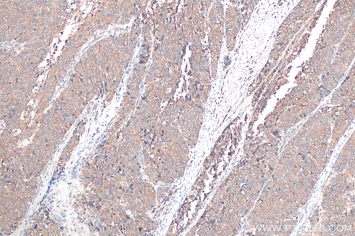 Immunohistochemical analysis of paraffin-embedded human stomach cancer tissue slide using KHC0912 (RAB2A IHC Kit).