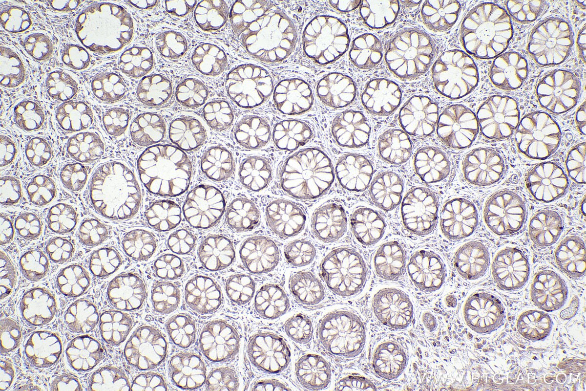 Immunohistochemical analysis of paraffin-embedded human rectal cancer tissue slide using KHC2519 (RAB30 IHC Kit).