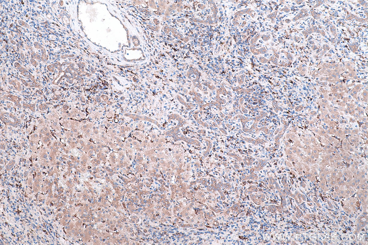 Immunohistochemical analysis of paraffin-embedded human liver cancer tissue slide using KHC0451 (RAB32 IHC Kit).