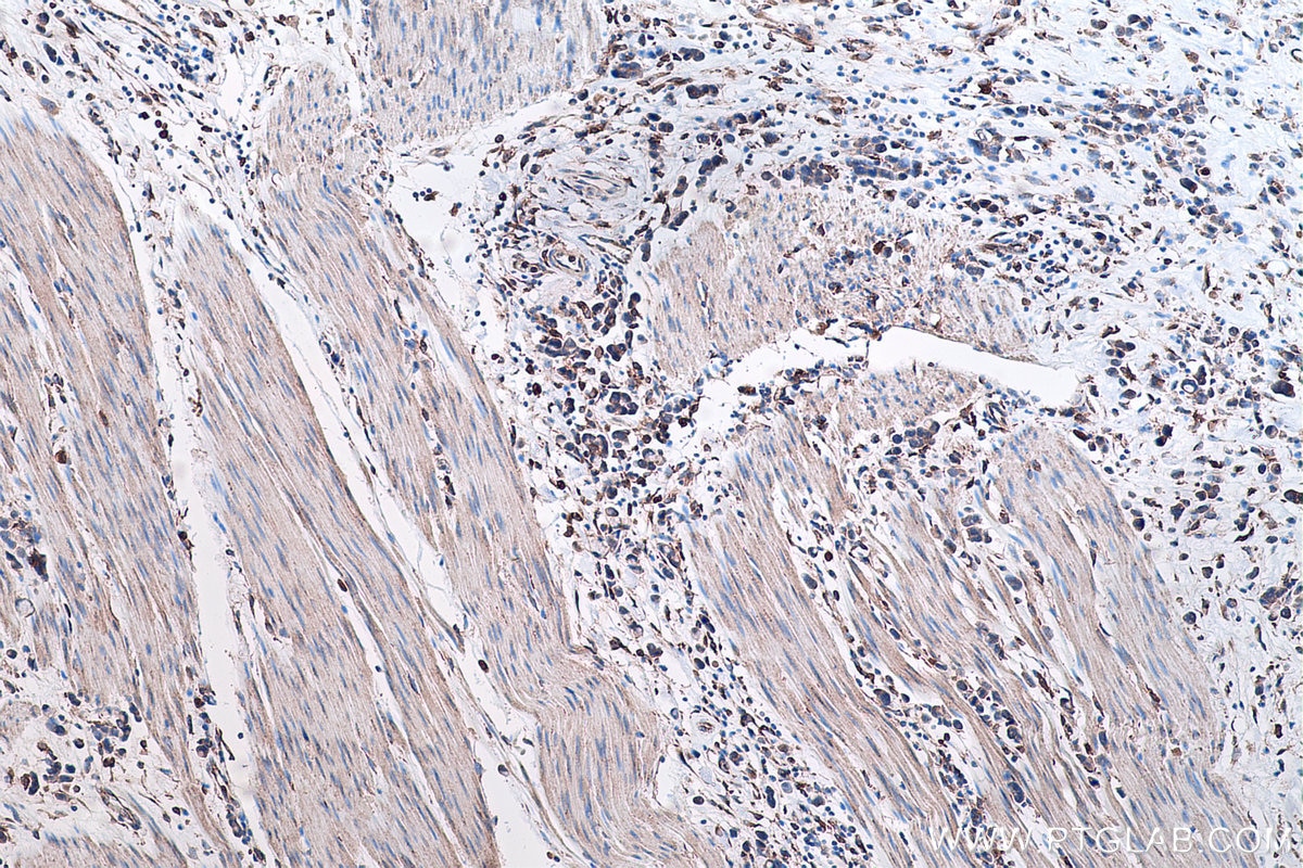 Immunohistochemical analysis of paraffin-embedded human stomach cancer tissue slide using KHC0451 (RAB32 IHC Kit).
