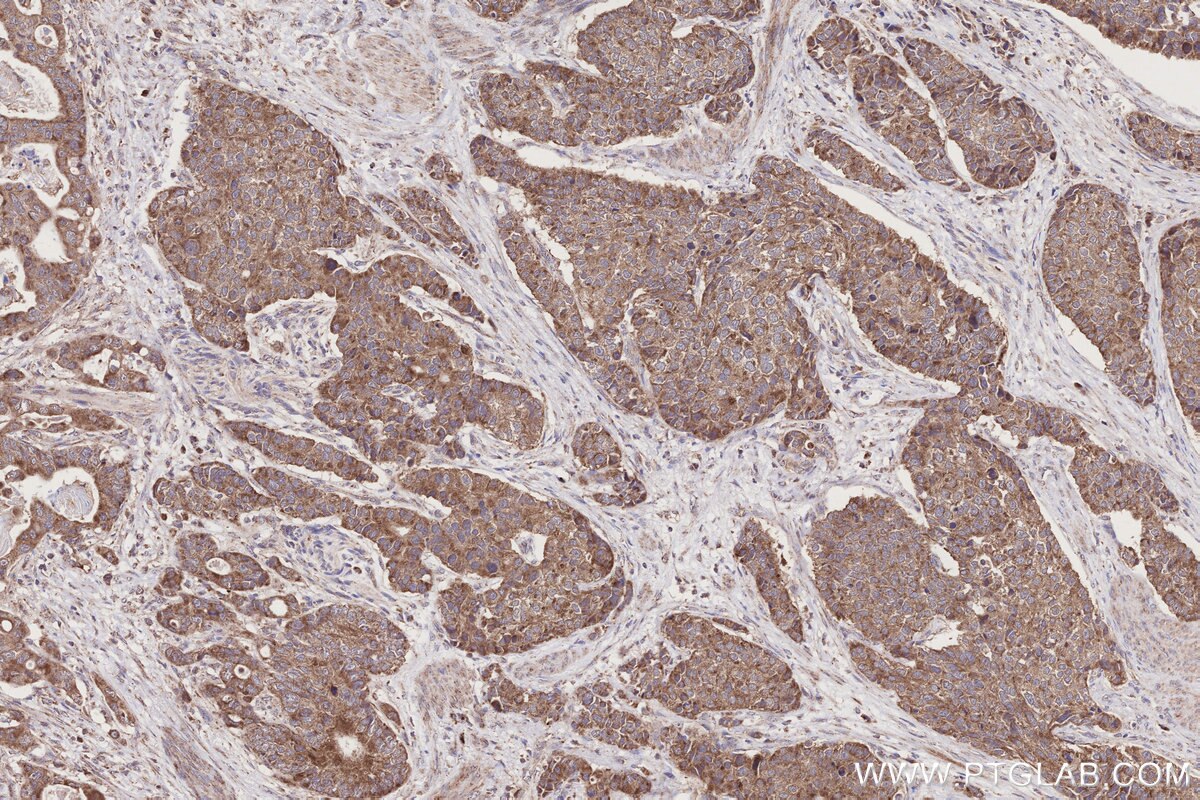 Immunohistochemical analysis of paraffin-embedded human stomach cancer tissue slide using KHC2785 (RAB39B IHC Kit).