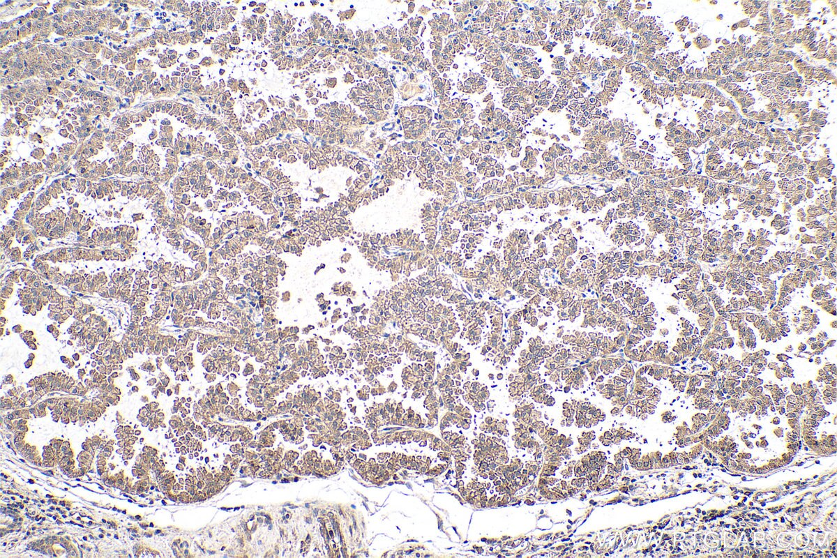 Immunohistochemical analysis of paraffin-embedded human lung cancer tissue slide using KHC0700 (RAB7A IHC Kit).