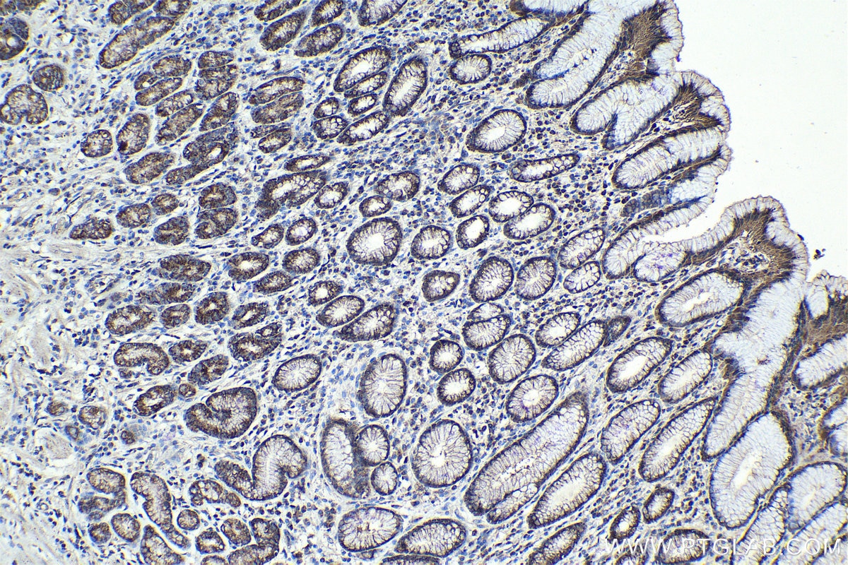Immunohistochemical analysis of paraffin-embedded human stomach cancer tissue slide using KHC0992 (RABEPK IHC Kit).