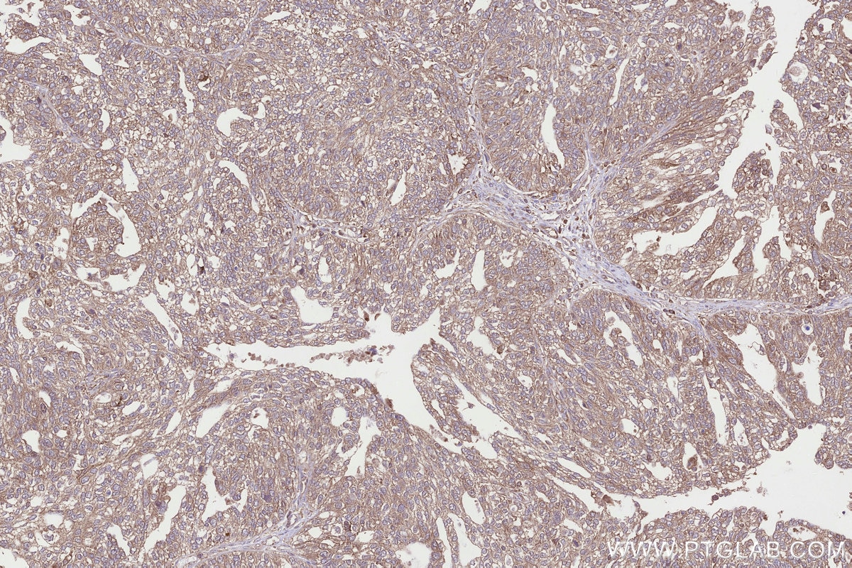 Immunohistochemical analysis of paraffin-embedded human ovary cancer tissue slide using KHC3307 (RABGGTA IHC Kit).