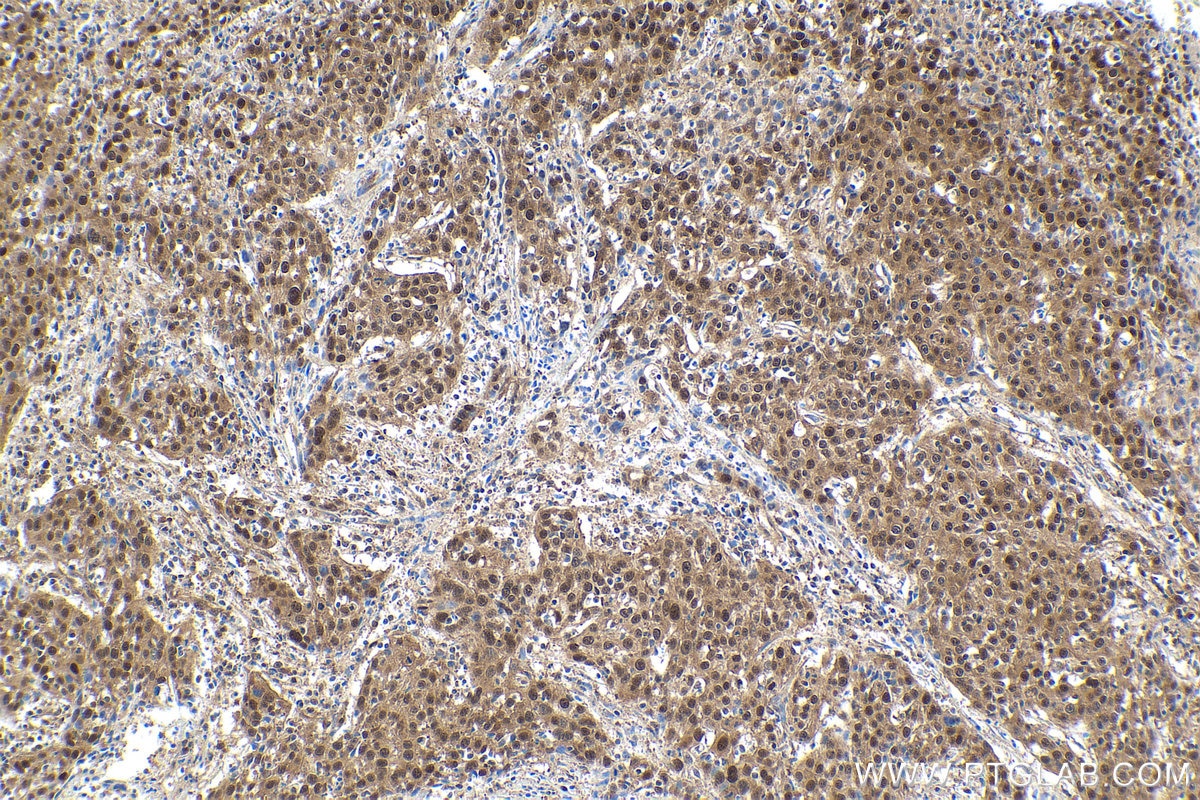 Immunohistochemical analysis of paraffin-embedded human cervical cancer tissue slide using KHC1629 (RAD23B IHC Kit).