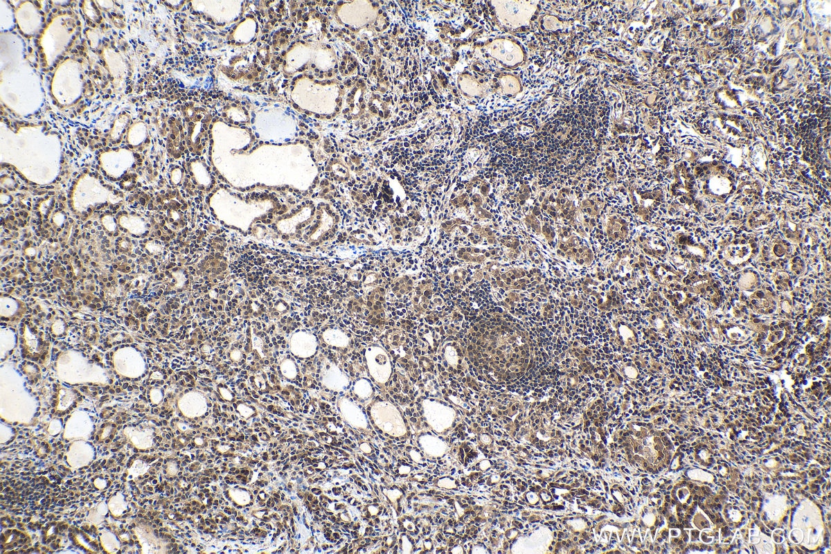 Immunohistochemical analysis of paraffin-embedded human thyroid cancer tissue slide using KHC1629 (RAD23B IHC Kit).