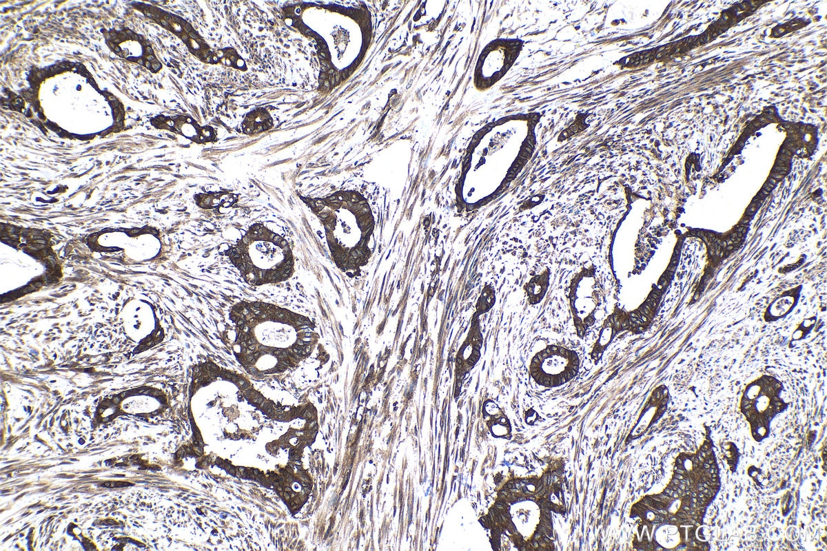 Immunohistochemical analysis of paraffin-embedded human urothelial carcinoma tissue slide using KHC1506 (RAF1 IHC Kit).