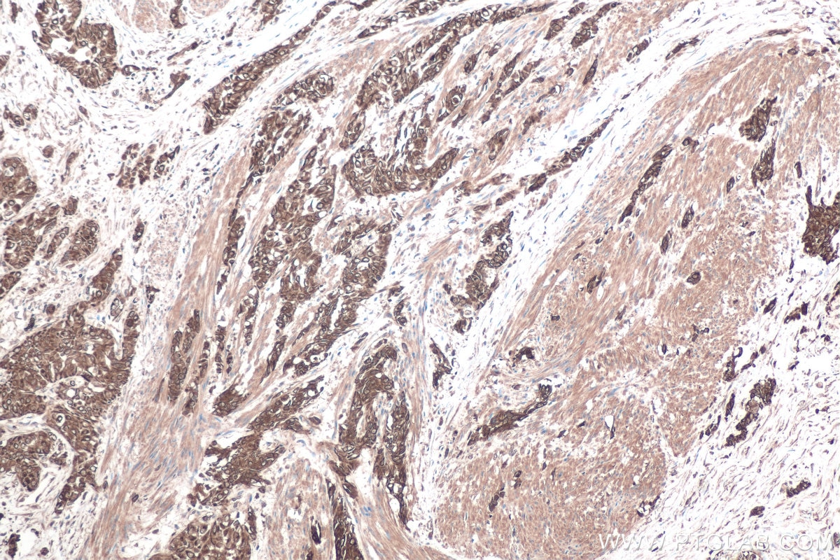 Immunohistochemical analysis of paraffin-embedded human urothelial carcinoma tissue slide using KHC0881 (RANBP1 IHC Kit).