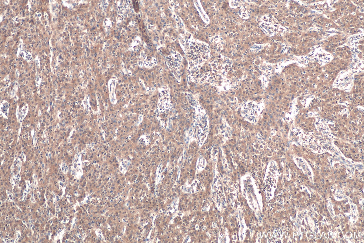 Immunohistochemical analysis of paraffin-embedded human cervical cancer tissue slide using KHC0881 (RANBP1 IHC Kit).