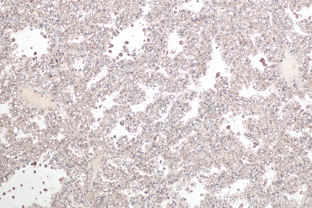 Immunohistochemical analysis of paraffin-embedded human lung cancer tissue slide using KHC0881 (RANBP1 IHC Kit).