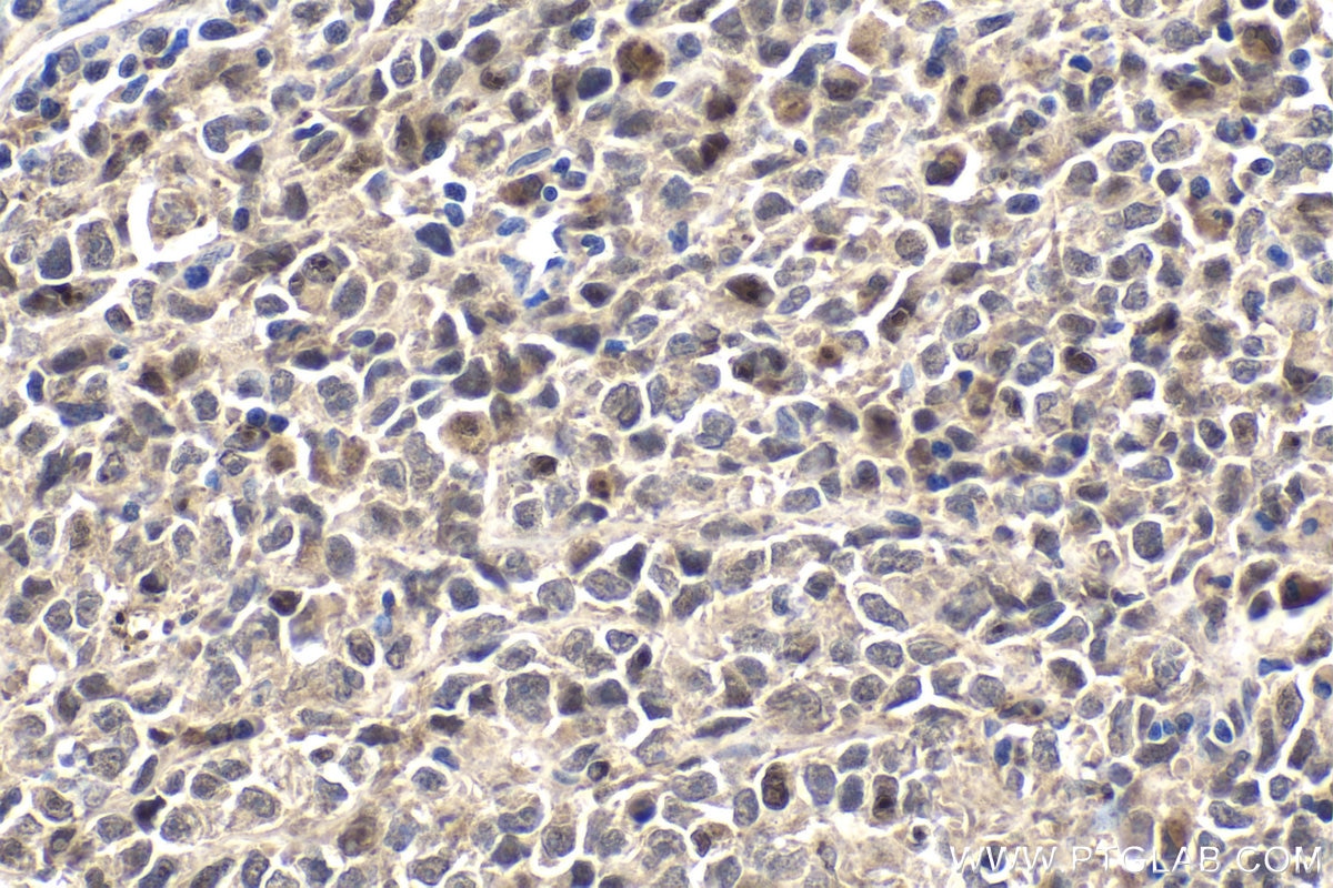 Immunohistochemical analysis of paraffin-embedded human malignant melanoma tissue slide using KHC1793 (RANBP10 IHC Kit).