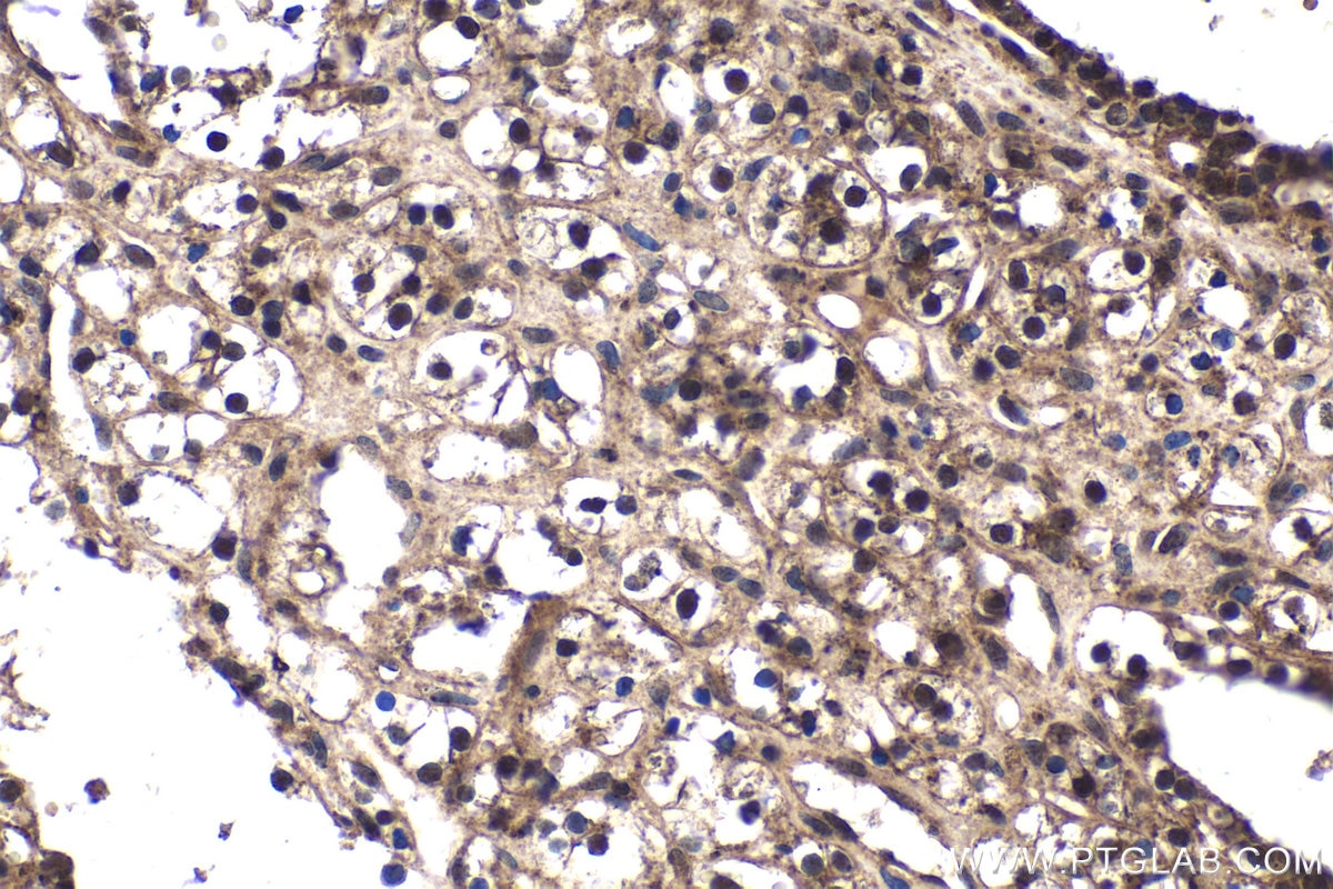 Immunohistochemical analysis of paraffin-embedded human renal cell carcinoma tissue slide using KHC1793 (RANBP10 IHC Kit).