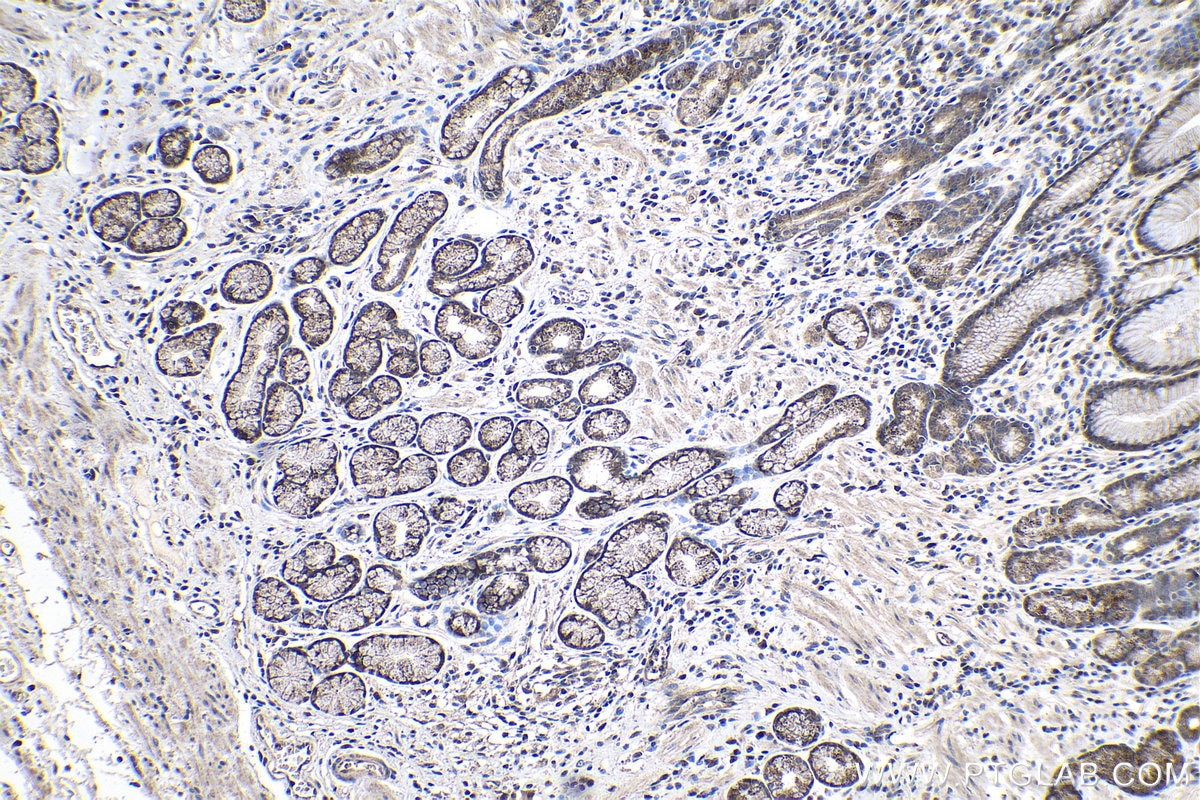 Immunohistochemical analysis of paraffin-embedded human stomach cancer tissue slide using KHC1041 (RANBP9 IHC Kit).