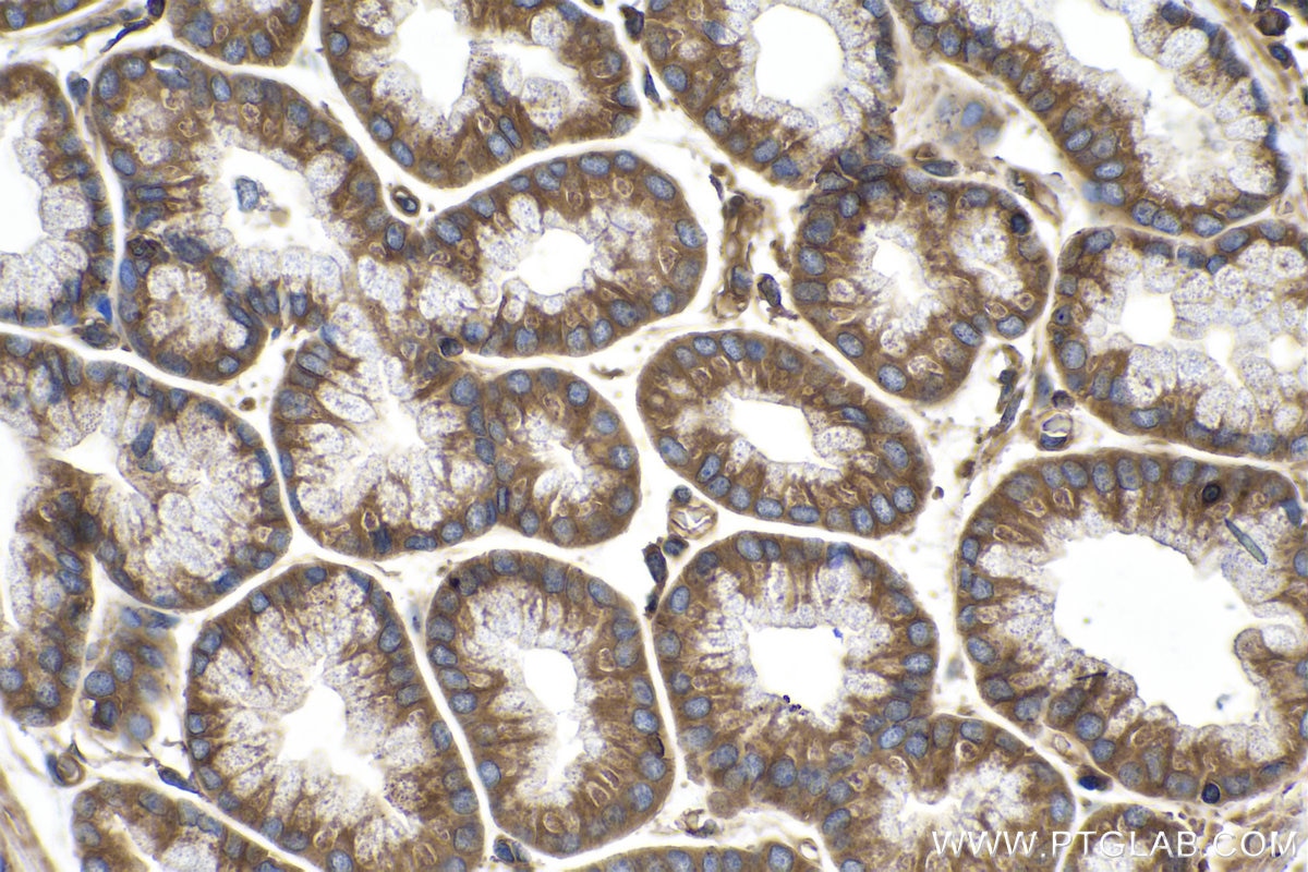 Immunohistochemical analysis of paraffin-embedded human stomach cancer tissue slide using KHC0121 (RAP1B IHC Kit).