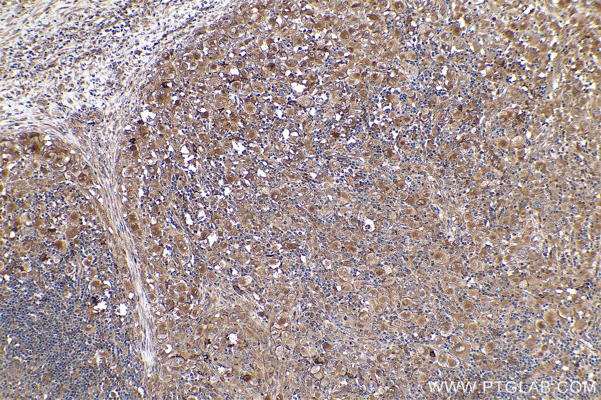Immunohistochemical analysis of paraffin-embedded human lymphoma tissue slide using KHC0922 (RAP1GDS1 IHC Kit).