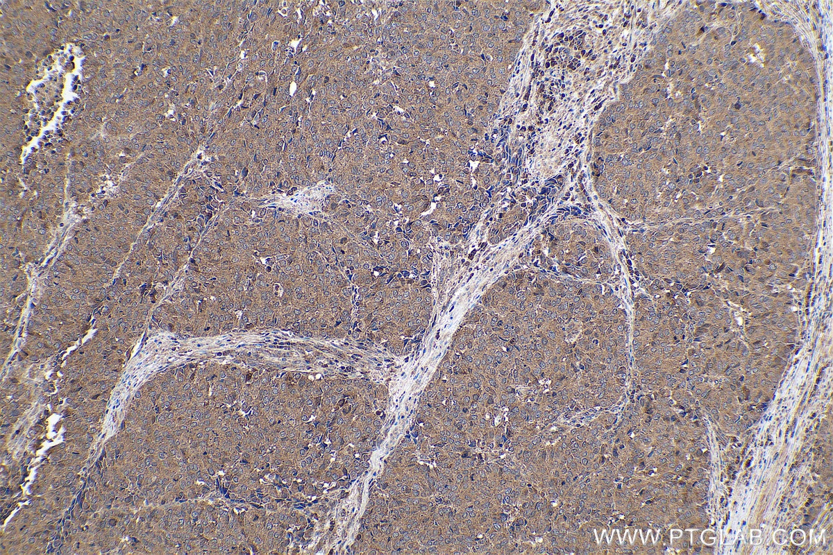 Immunohistochemical analysis of paraffin-embedded human stomach cancer tissue slide using KHC0922 (RAP1GDS1 IHC Kit).