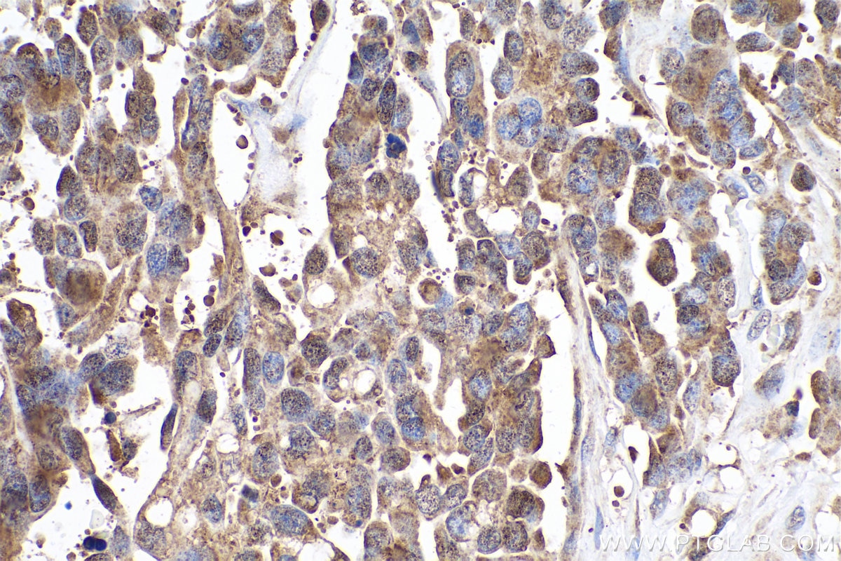 Immunohistochemical analysis of paraffin-embedded human colon cancer tissue slide using KHC0922 (RAP1GDS1 IHC Kit).