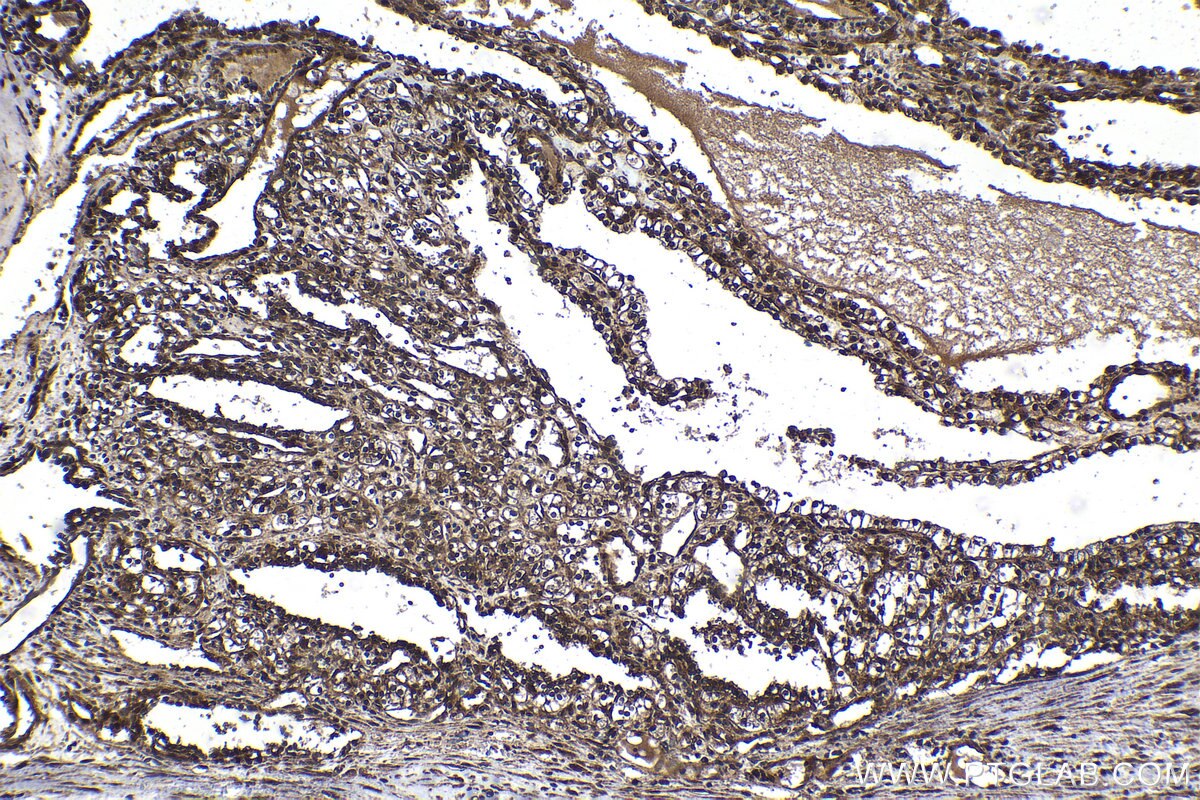 Immunohistochemical analysis of paraffin-embedded human renal cell carcinoma tissue slide using KHC1522 (RARB IHC Kit).