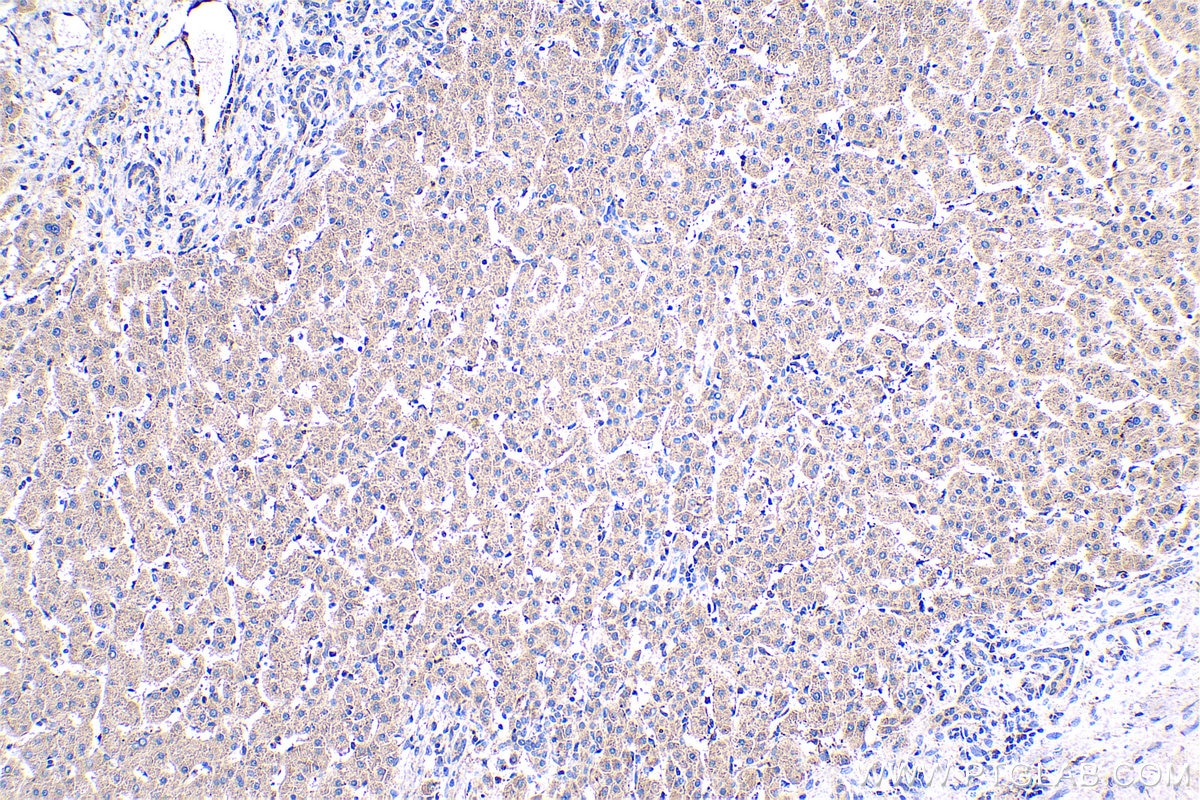 Immunohistochemical analysis of paraffin-embedded human liver cancer tissue slide using KHC0452 (RARRES2 IHC Kit).
