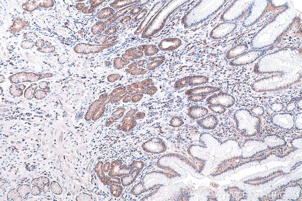 Immunohistochemical analysis of paraffin-embedded human stomach cancer tissue slide using KHC0867 (RARS1 IHC Kit).