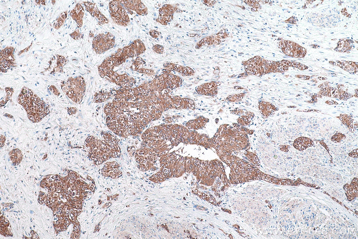 Immunohistochemical analysis of paraffin-embedded human urothelial carcinoma tissue slide using KHC0867 (RARS1 IHC Kit).