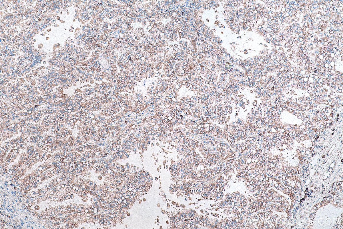Immunohistochemical analysis of paraffin-embedded human lung cancer tissue slide using KHC0867 (RARS1 IHC Kit).