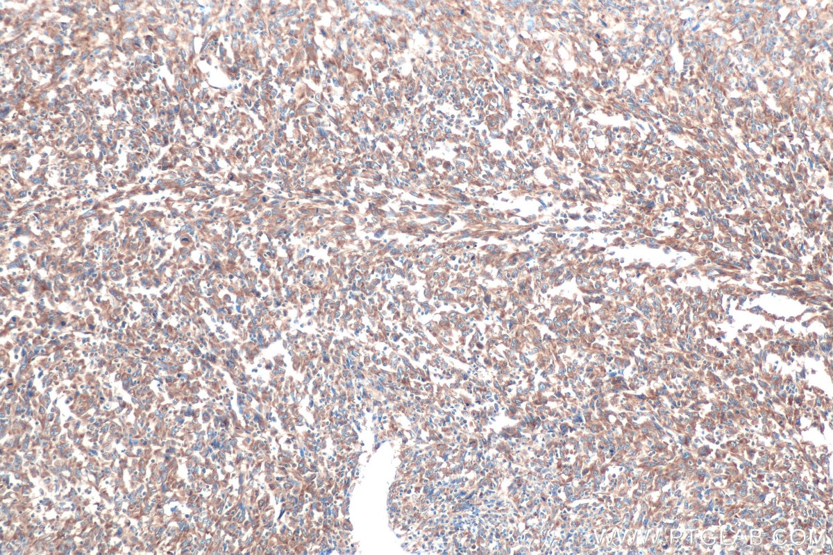 Immunohistochemical analysis of paraffin-embedded human endometrial cancer tissue slide using KHC0867 (RARS1 IHC Kit).