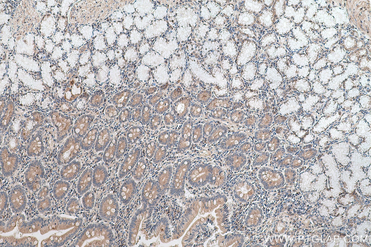 Immunohistochemical analysis of paraffin-embedded human stomach cancer tissue slide using KHC0637 (RASEF IHC Kit).