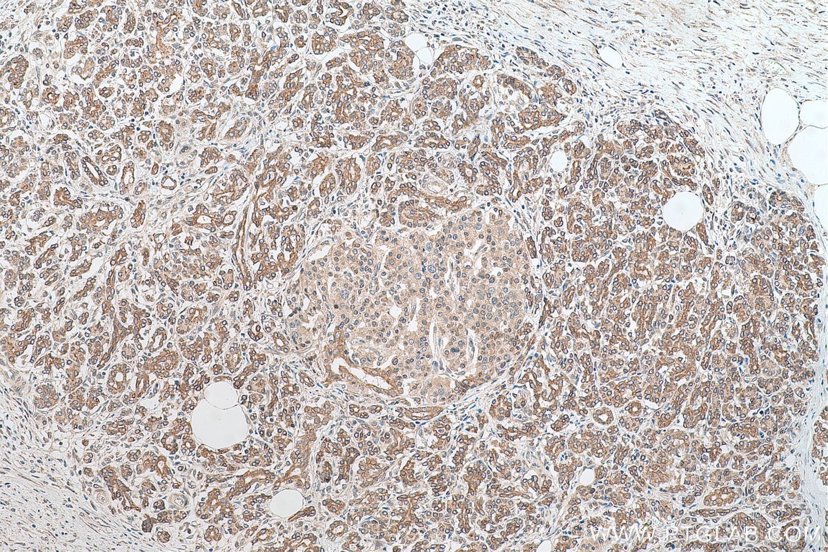 Immunohistochemical analysis of paraffin-embedded human pancreas cancer tissue slide using KHC0637 (RASEF IHC Kit).