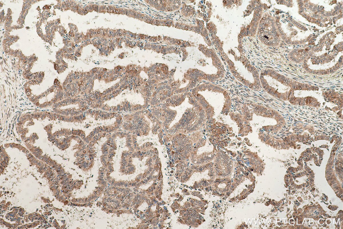 Immunohistochemical analysis of paraffin-embedded human ovary tumor tissue slide using KHC0637 (RASEF IHC Kit).