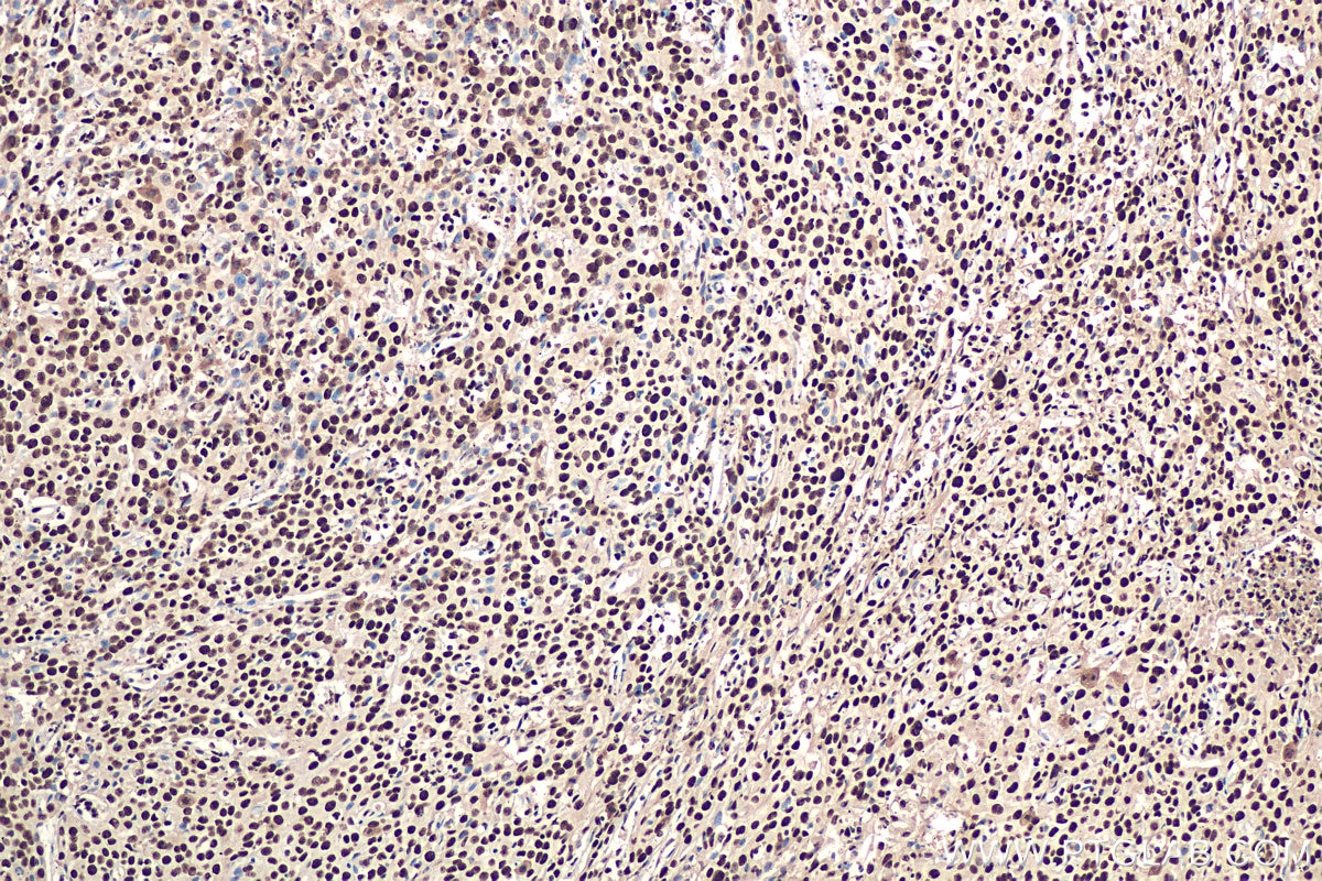 Immunohistochemical analysis of paraffin-embedded human cervical cancer tissue slide using KHC0918 (RBBP4 IHC Kit).