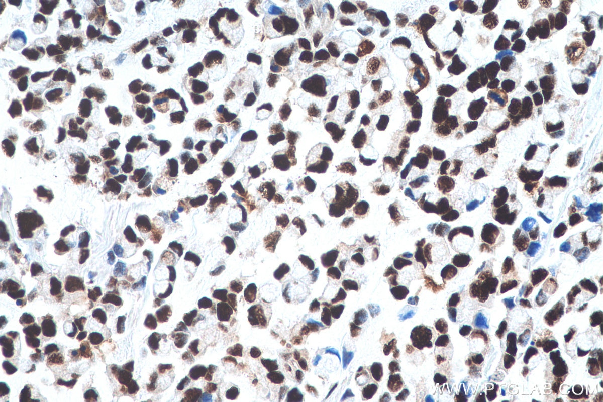 Immunohistochemical analysis of paraffin-embedded human colon cancer tissue slide using KHC0918 (RBBP4 IHC Kit).