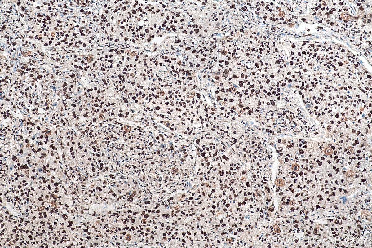 Immunohistochemical analysis of paraffin-embedded human lung cancer tissue slide using KHC0918 (RBBP4 IHC Kit).