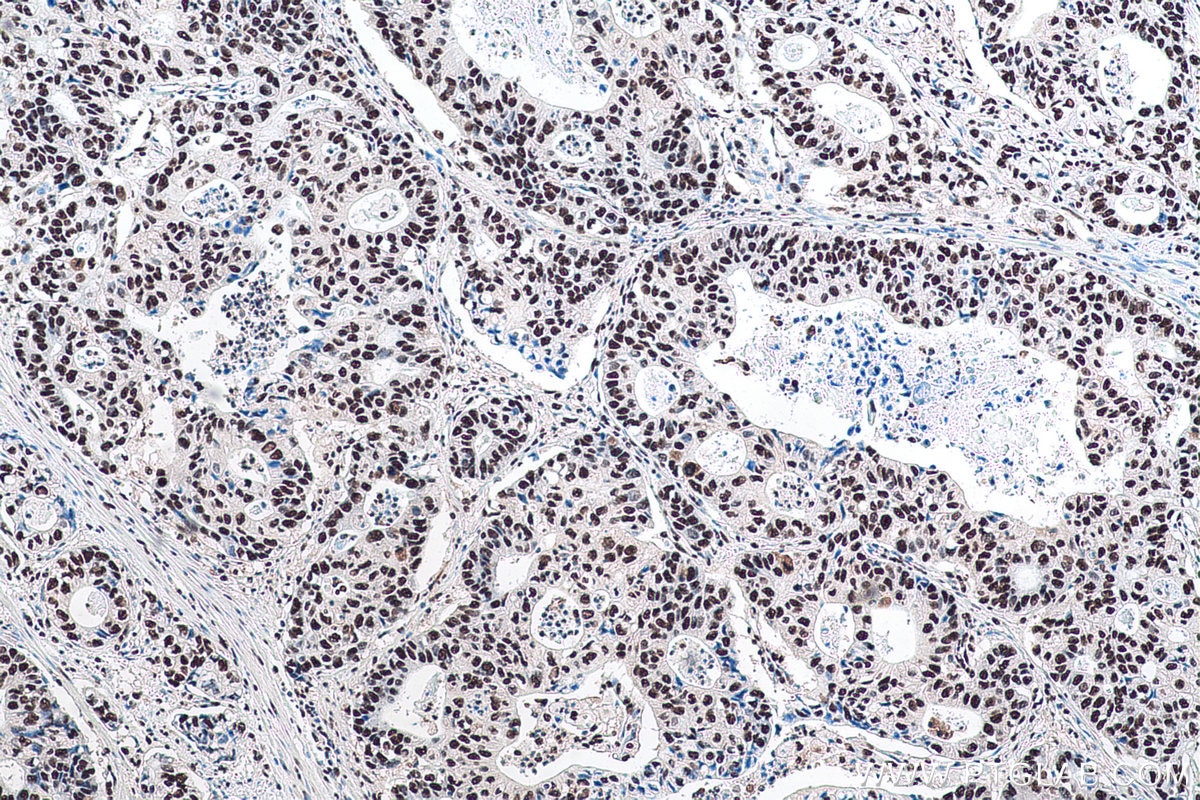 Immunohistochemical analysis of paraffin-embedded human stomach cancer tissue slide using KHC0918 (RBBP4 IHC Kit).