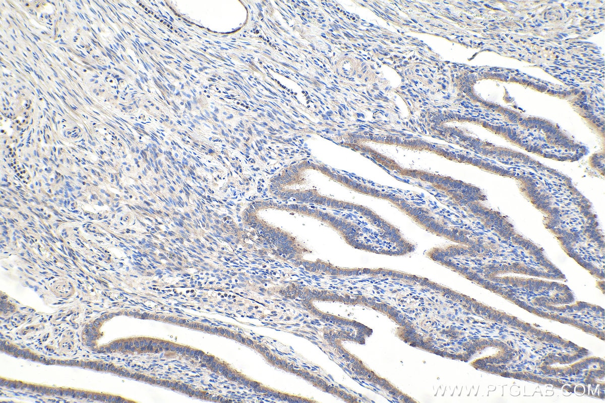 Immunohistochemical analysis of paraffin-embedded human ovary tumor tissue slide using KHC1966 (RBFOX1/A2BP1 IHC Kit).