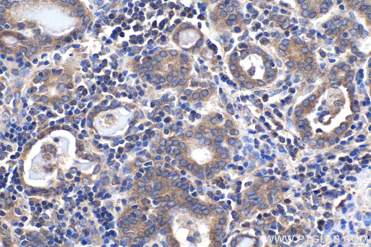 Immunohistochemical analysis of paraffin-embedded human thyroid cancer tissue slide using KHC1966 (RBFOX1/A2BP1 IHC Kit).