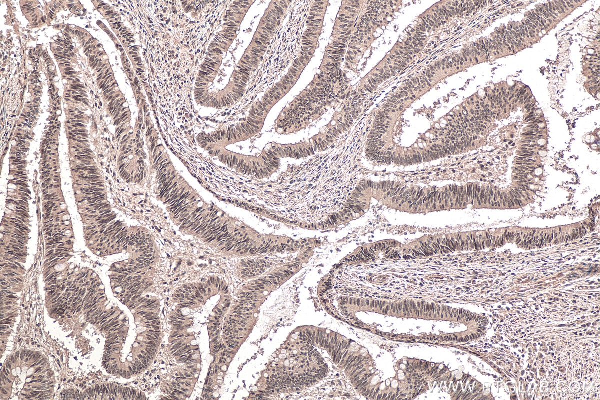 Immunohistochemical analysis of paraffin-embedded human colon cancer tissue slide using KHC0151 (RBM15B IHC Kit).