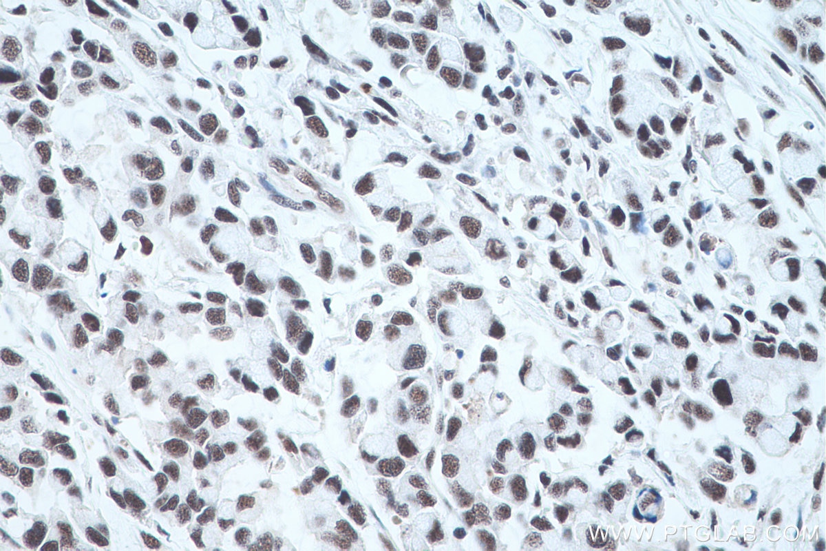 Immunohistochemical analysis of paraffin-embedded human colon cancer tissue slide using KHC0497 (RBM39 IHC Kit).